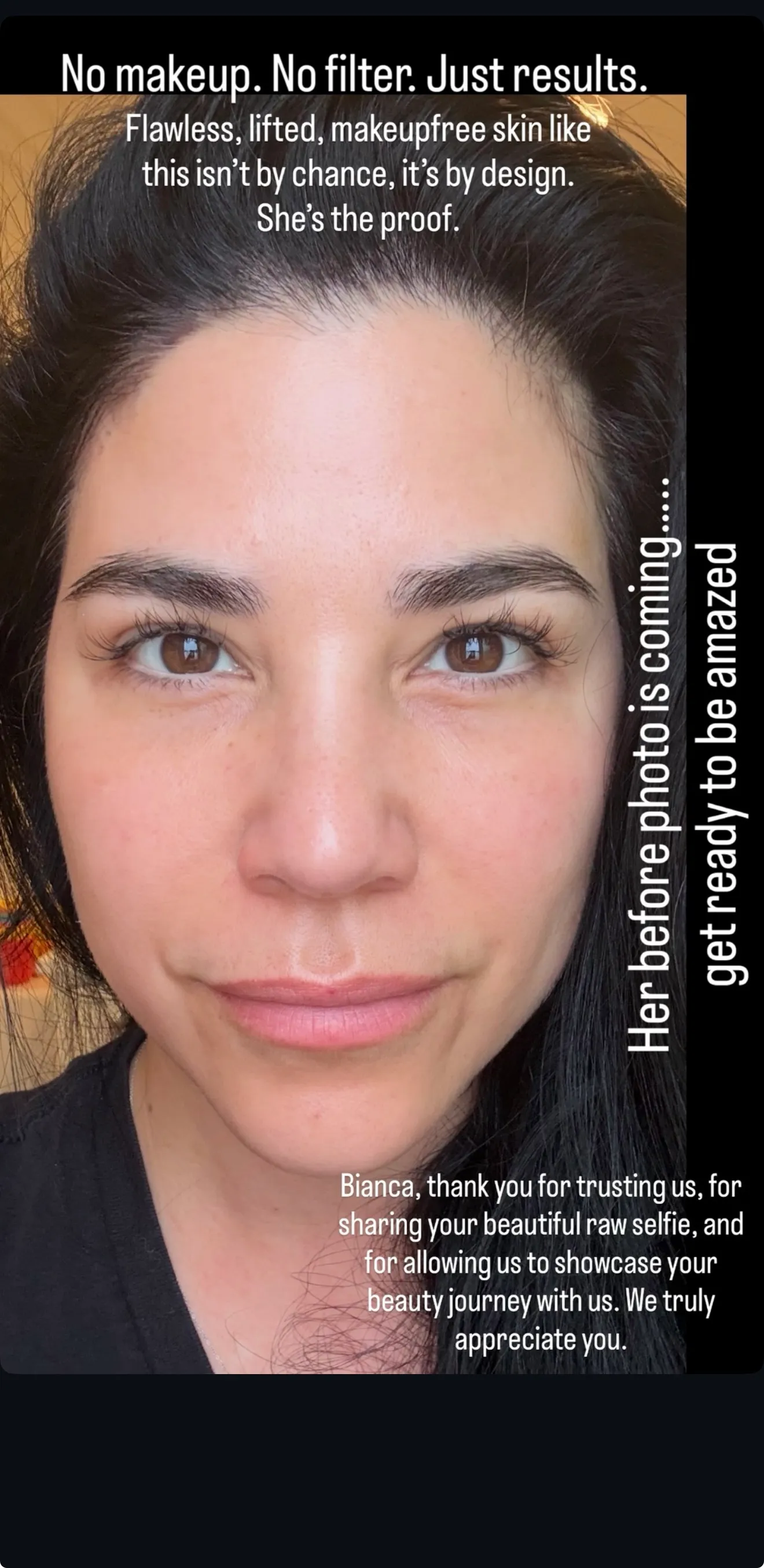 Bianca — no makeup, no filter, just results from her LeMed Spa skin journey