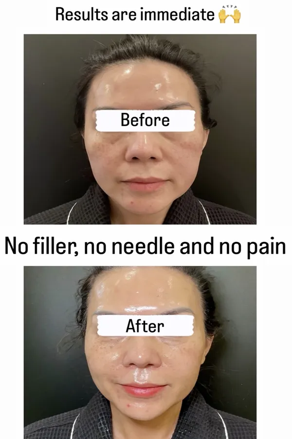 XERF++ Stack before and after — immediate skin tightening results